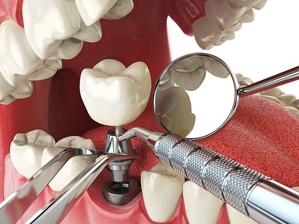 Best Emergency Dentist for Knocked-Out Tooth in Braddock, VA